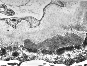 F,74y. | membranous glomerulopathy